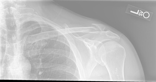 Mangled clavicle(2)