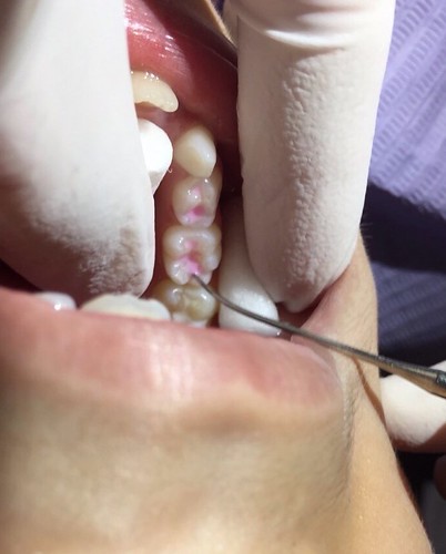 【推薦】讓妹妹不害怕的兒童牙科珍所，到高雄西河牙醫診所做第一大臼齒窩溝封填(溝隙封填)_第4步_窩溝封填3，用探針讓液體流進去